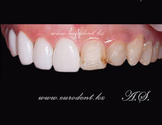 Сеть круглосуточных стоматологических клиник Eurodent (Евродент), Примеры работ - фото 8
