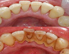 Стоматология Dental & Beauty Clinic Айнабулак (Дентал энд Бьюти Клиник Айнабулак), Примеры работ - фото 12