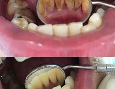 Стоматология Dental & Beauty Clinic Айнабулак (Дентал энд Бьюти Клиник Айнабулак), Примеры работ - фото 17