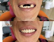 Стоматология Dental & Beauty Clinic Айнабулак (Дентал энд Бьюти Клиник Айнабулак), Примеры работ - фото 9
