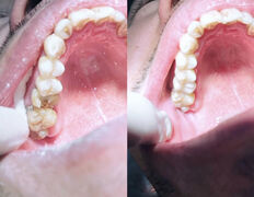 Стоматология Dental & Beauty Clinic Айнабулак (Дентал энд Бьюти Клиник Айнабулак), Примеры работ - фото 7