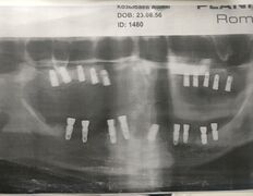 Стоматология Dental & Beauty Clinic Айнабулак (Дентал энд Бьюти Клиник Айнабулак), Примеры работ - фото 19