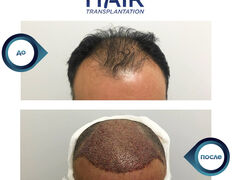 null Клиника доктора Кобландина, Трихология (пересадка волос) - фото 3