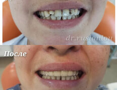 Стоматология Dental & Beauty Clinic Айнабулак (Дентал энд Бьюти Клиник Айнабулак), Примеры работ - фото 8