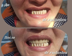 Стоматология Dental & Beauty Clinic Айнабулак (Дентал энд Бьюти Клиник Айнабулак), Примеры работ - фото 5