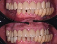 Стоматология Doctor-Stom (Доктор-Стом), Имплантация зубов - фото 1