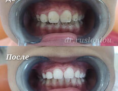 Стоматология Dental & Beauty Clinic Айнабулак (Дентал энд Бьюти Клиник Айнабулак), Примеры работ - фото 1