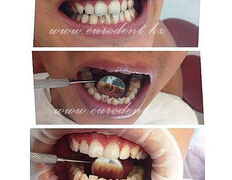 Сеть круглосуточных стоматологических клиник Eurodent (Евродент), Примеры работ - фото 2
