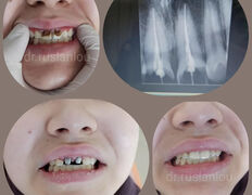 Стоматологический кабинет Айнабулак Дент, Примеры работ - фото 4