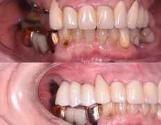 Стоматология Doctor-Stom (Доктор-Стом), Имплантация зубов - фото 2