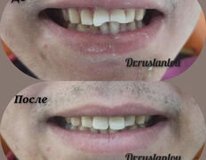 Стоматология Dental & Beauty Clinic Айнабулак (Дентал энд Бьюти Клиник Айнабулак), Примеры работ - фото 6