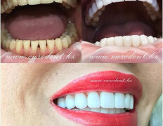 Сеть круглосуточных стоматологических клиник Eurodent (Евродент), Примеры работ - фото 5