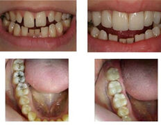 Стоматология Dental & Beauty Clinic Айнабулак (Дентал энд Бьюти Клиник Айнабулак), Примеры работ - фото 13