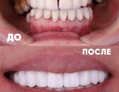 Стоматология My Dent (Май Дент), Примеры работ - фото 1