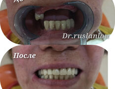 Стоматология Dental & Beauty Clinic Айнабулак (Дентал энд Бьюти Клиник Айнабулак), Примеры работ - фото 3