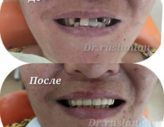 Стоматология Dental & Beauty Clinic Айнабулак (Дентал энд Бьюти Клиник Айнабулак), Примеры работ - фото 2