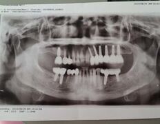 Стоматологический кабинет Айнабулак Дент, Примеры работ - фото 19