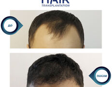 null Клиника доктора Кобландина, Трихология (пересадка волос) - фото 10