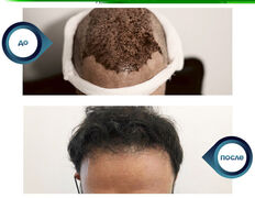 null Клиника пластической хирургии доктора Кобландина, Пересадка волос - фото 1
