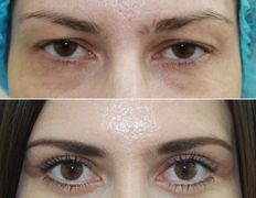 Клиника красоты и здоровья ЮТА, Блефаропластика - фото 20
