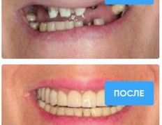 Стоматология Bas dent (Бас дент), Примеры работ - фото 4