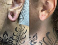Клиника красоты и здоровья ЮТА, Отопластика - фото 10
