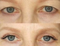 Клиника красоты и здоровья ЮТА, Блефаропластика - фото 15