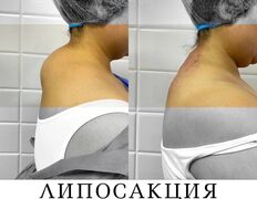 Клиника красоты и здоровья ЮТА, Липосакция холки - фото 12