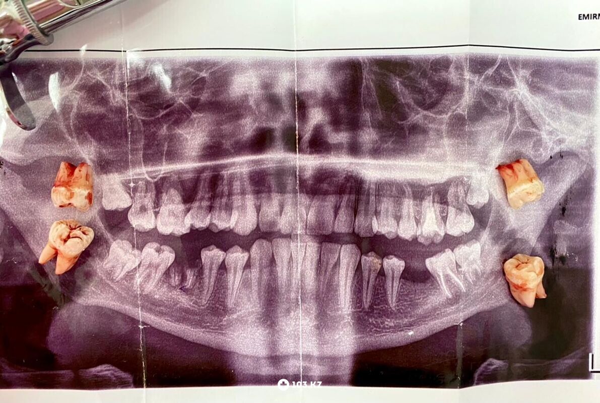 Наши работы Стоматология «EMIRSTOM (ЭМИРСТОМ)» - фото 1633919