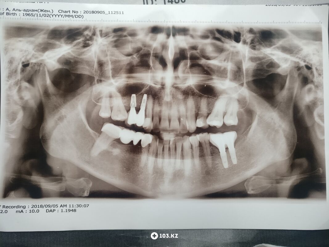 Примеры работ Стоматологический кабинет «Айнабулак Дент» - фото 1595753