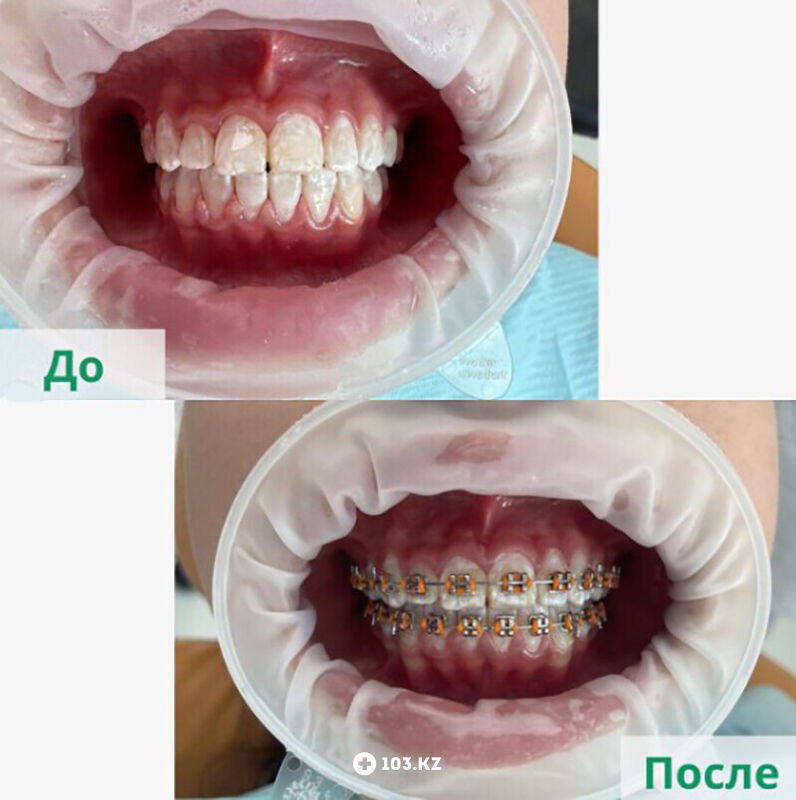 Ортодонтия Стоматология «Акжайык» - фото 1636415