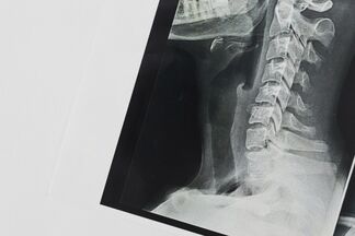 Информативнее рентгена, КТ и МРТ? Остеосцинтиграфия — метод, который позволяет врачу оценить весь костный скелет