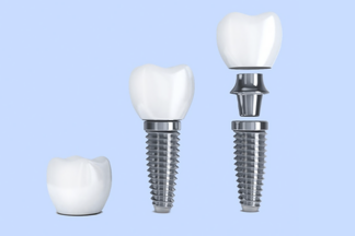 Что важно знать об имплантации зубов? Все об этапах подготовки, установки и восстановления
