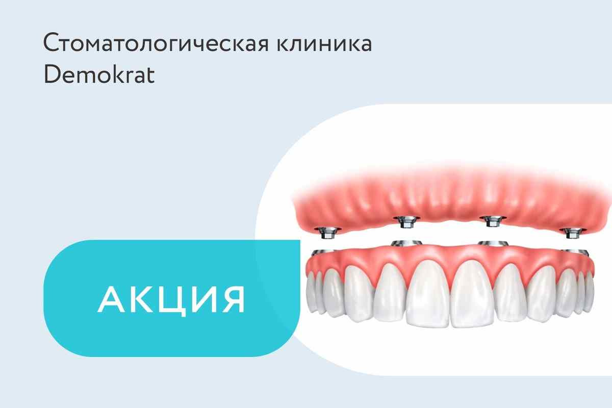 Акция «Протезирование зубов All-On-4»