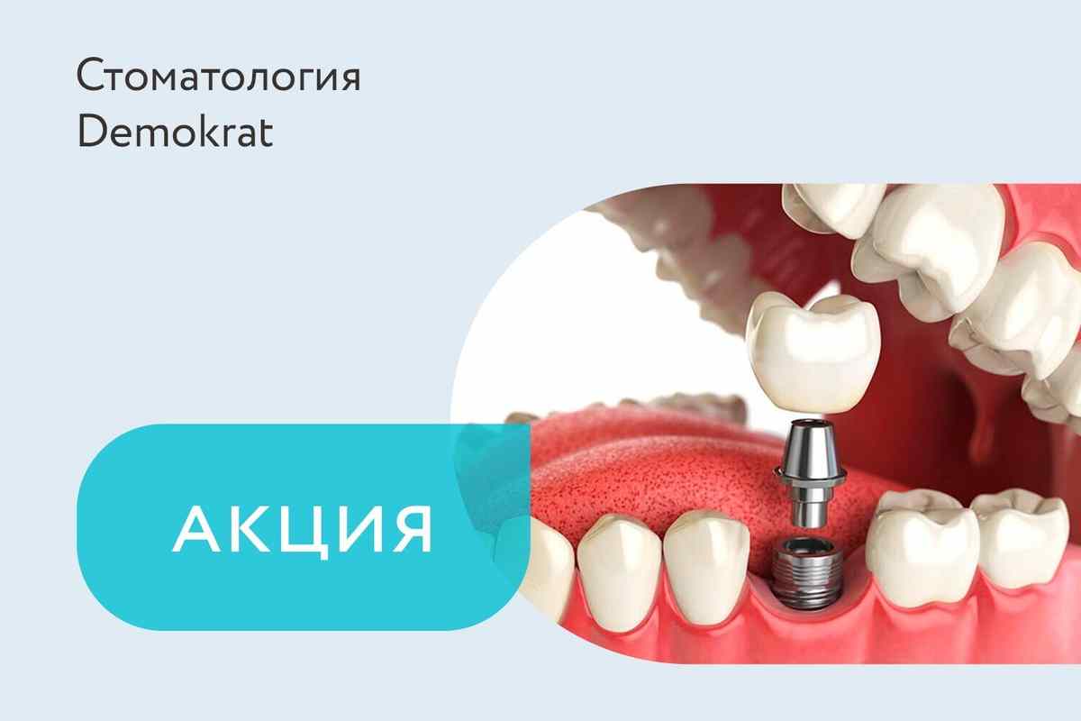 Акция «Рассрочка на импланты»