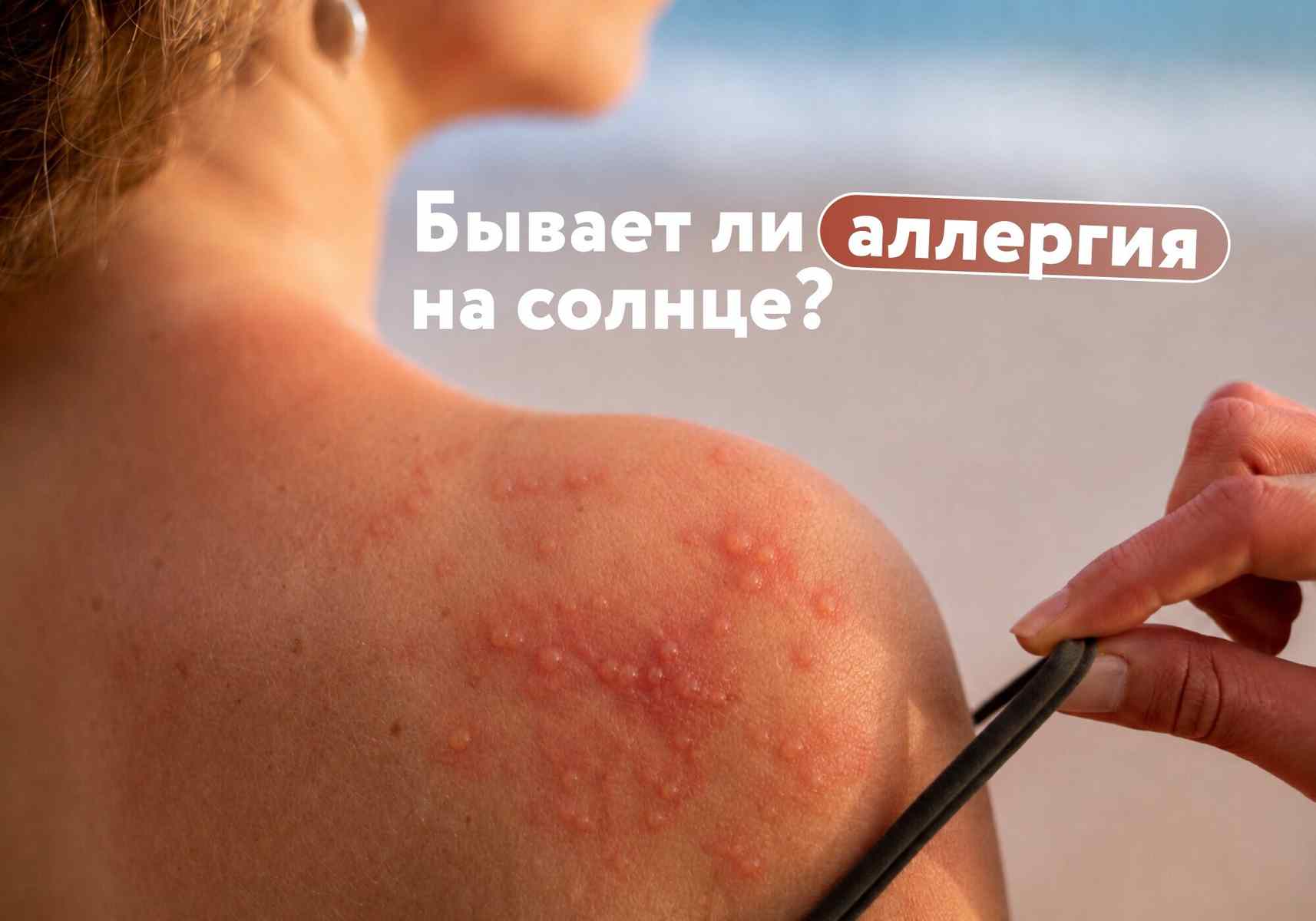 Аллергия на солнце: почему кожа реагирует на ультрафиолет