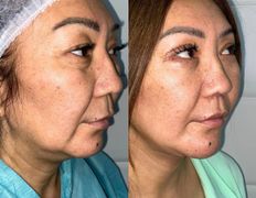 Клиника красоты и здоровья ЮТА, Подтяжка лица и шеи - фото 13