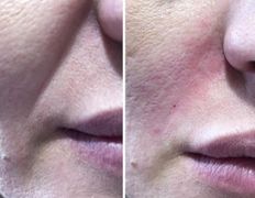 Клиника красоты и здоровья ЮТА, Коррекция носогубных морщин - фото 7