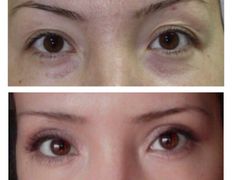 Клиника красоты и здоровья ЮТА, Блефаропластика - фото 10