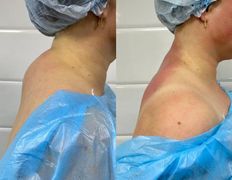 Клиника красоты и здоровья ЮТА, Липосакция холки - фото 6