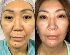 Клиника красоты и здоровья ЮТА, Подтяжка лица и шеи - фото 12