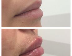 Клиника красоты и здоровья ЮТА, Увеличение губ - фото 1