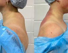 Клиника красоты и здоровья ЮТА, Липосакция холки - фото 5