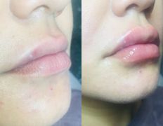Клиника красоты и здоровья ЮТА, Увеличение губ - фото 8