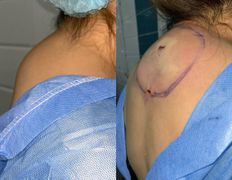 Клиника красоты и здоровья ЮТА, Липосакция холки - фото 16