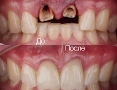 Стоматология One Dent (Уан Дент), Примеры работ - фото 4