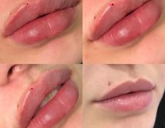 Клиника красоты и здоровья ЮТА, Увеличение губ - фото 4