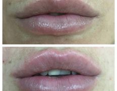 Клиника красоты и здоровья ЮТА, Увеличение губ - фото 11