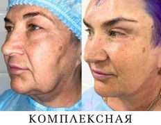 Клиника красоты и здоровья ЮТА, Подтяжка лица и шеи - фото 7
