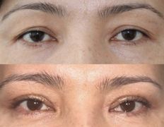 Клиника пластической хирургии и косметологии Надиалан Aesthetic (Надиалан Эстетик), Блефаропластика - фото 5